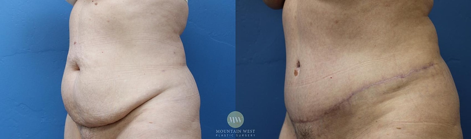 Drainless Tummy Tuck Before & After