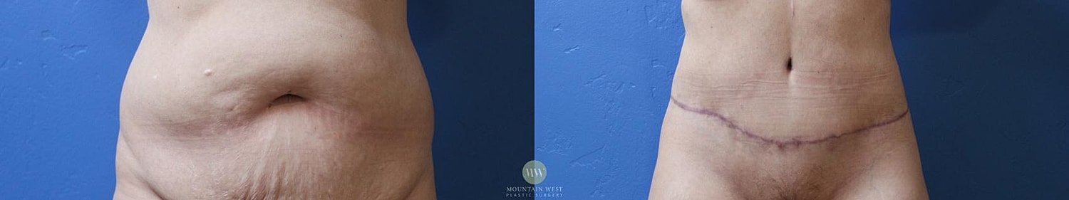 Drainless Tummy Tuck Before & After