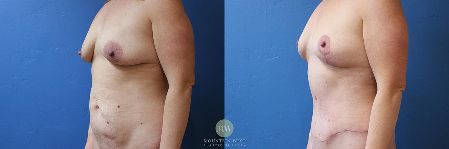 Drainless Tummy Tuck Before & After
