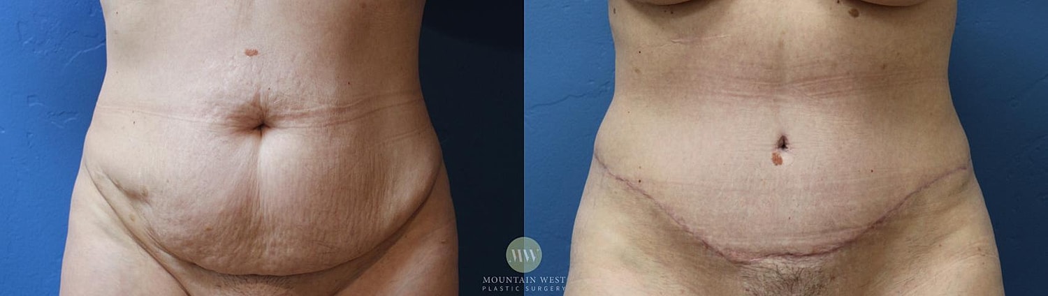 Abdominoplasty Before & After
