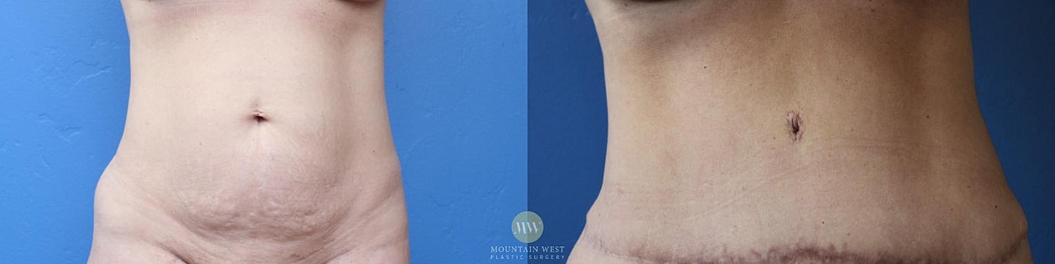 Abdominoplasty Before & After