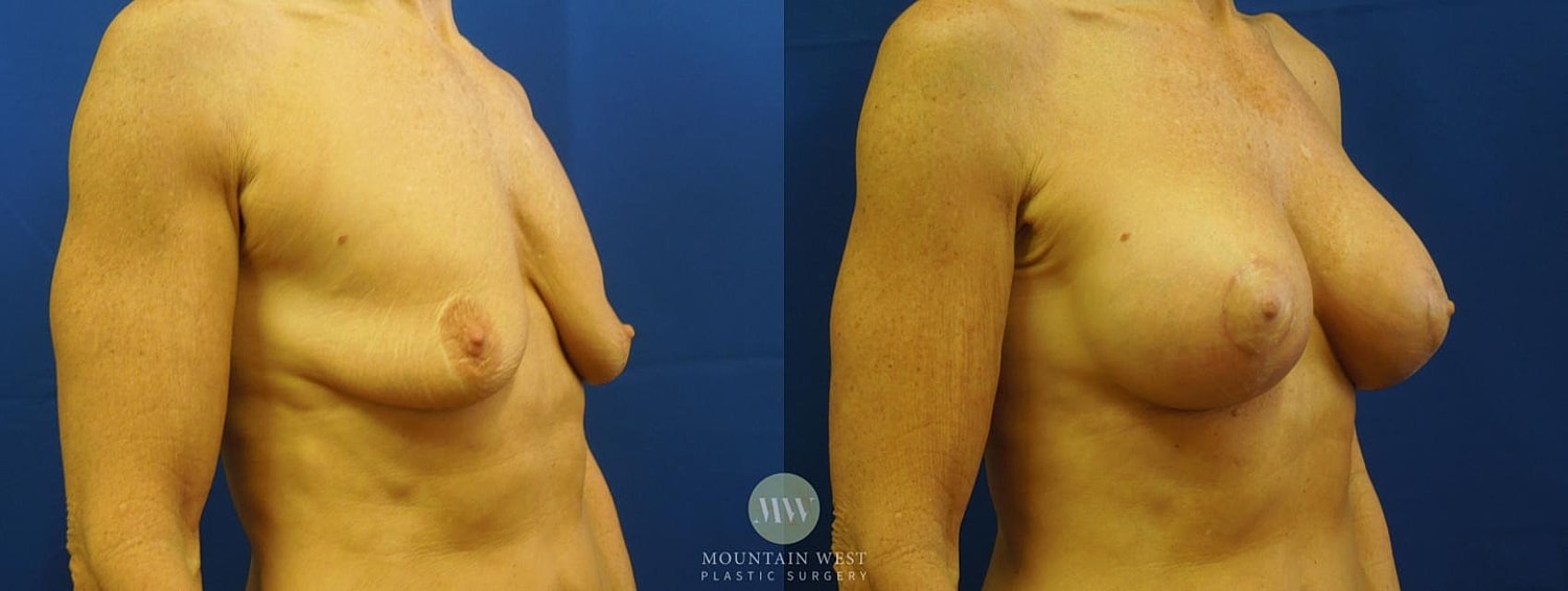 Breast Lift With Augmentation Before & After