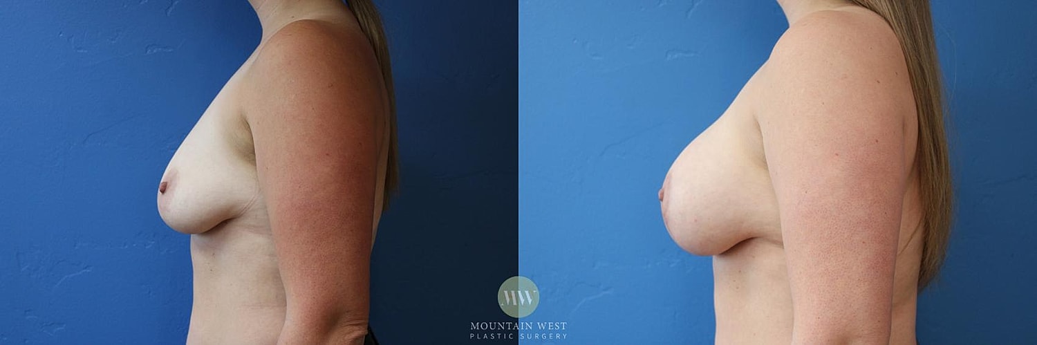 Breast Lift With Augmentation Before & After