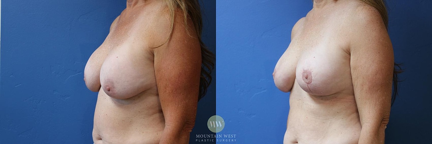 Breast Lift With Augmentation Before & After