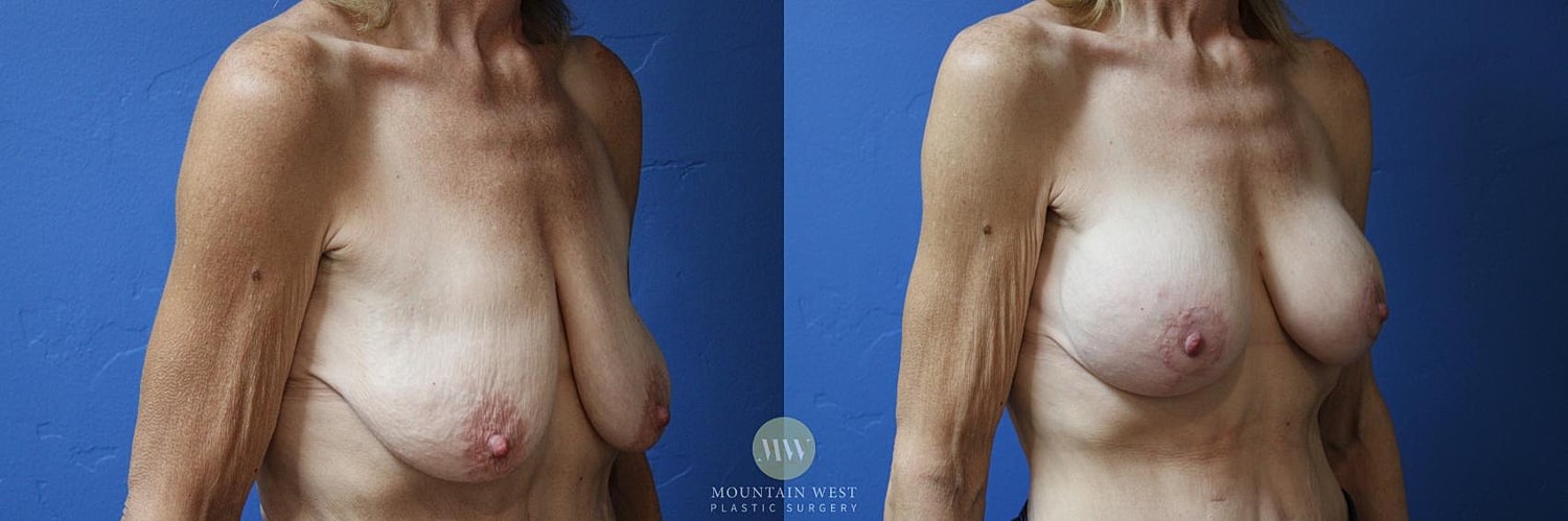 Breast Lift With Augmentation Before & After
