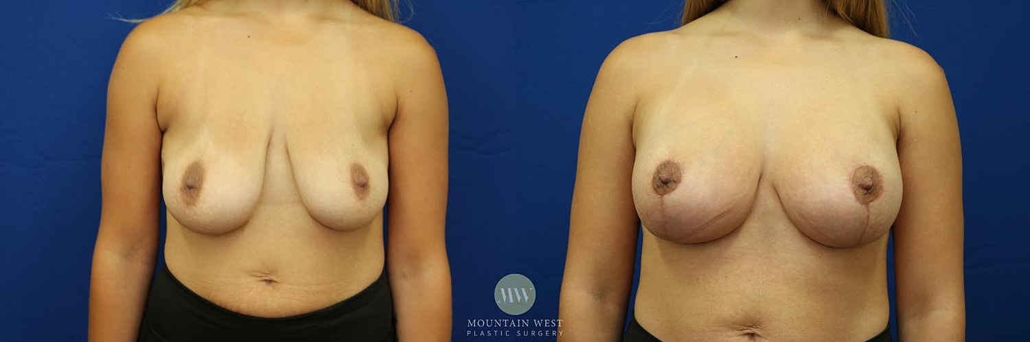 Breast Lift With Augmentation Before & After