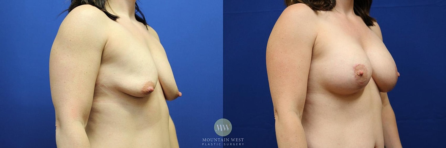 Breast Lift With Augmentation Before & After