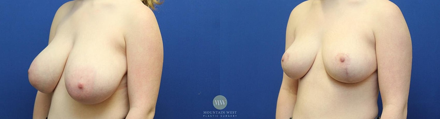 Breast Reduction Before & After
