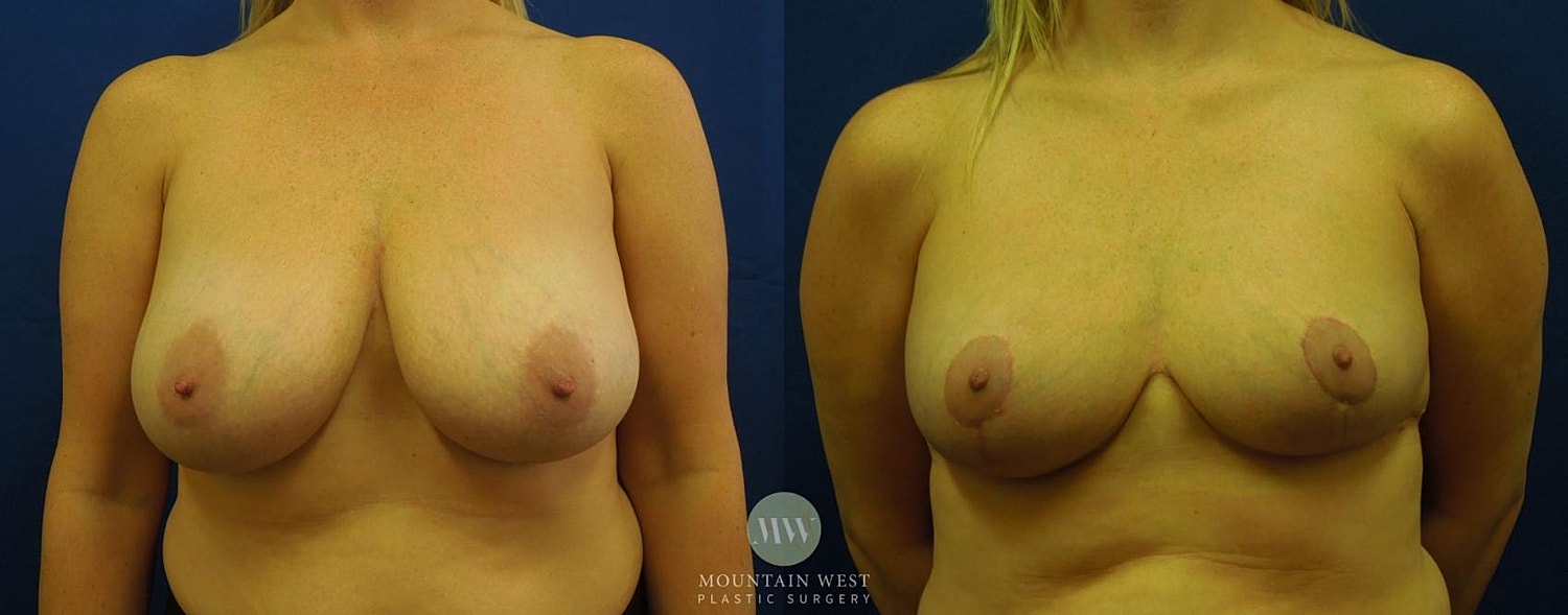 Breast Reduction Before & After