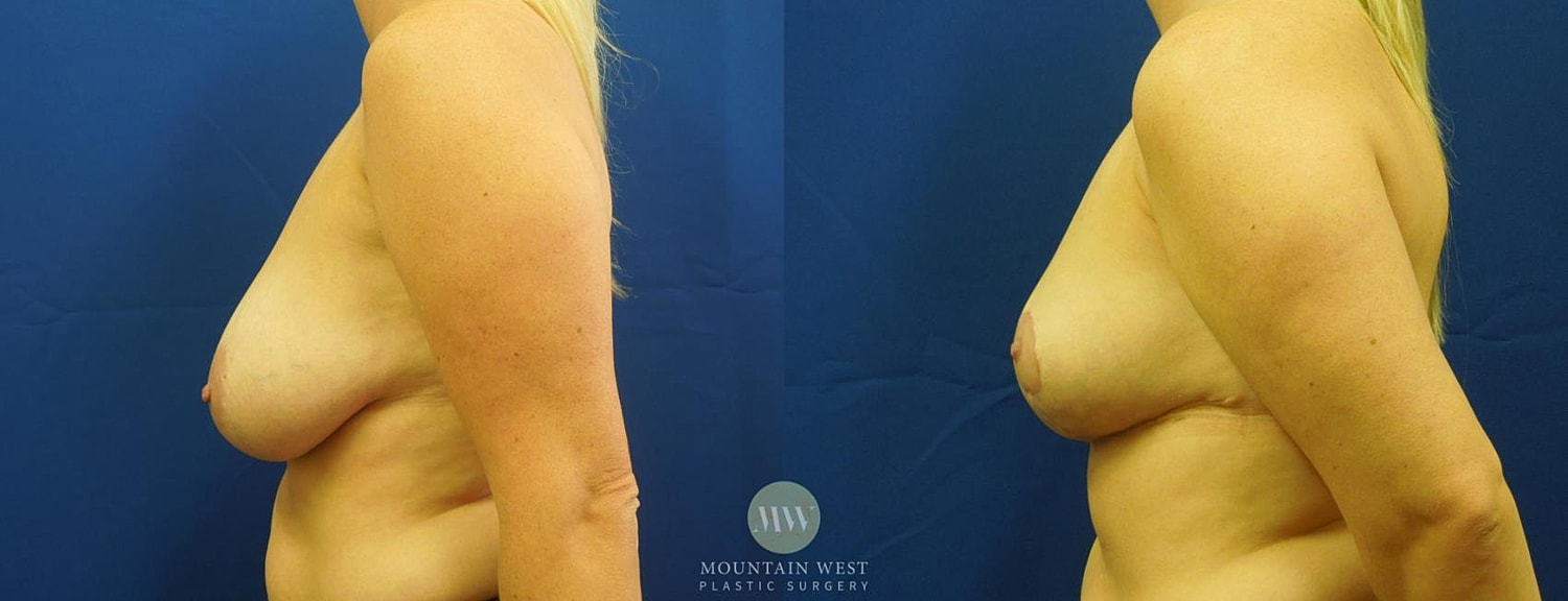 Breast Reduction Before & After
