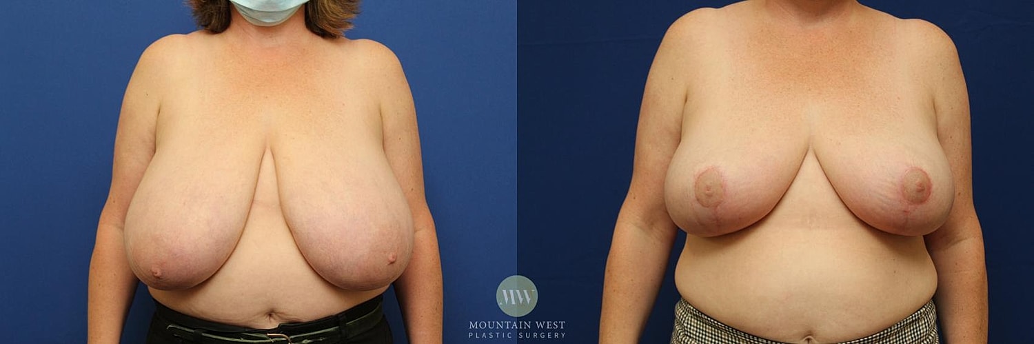 Breast Reduction Before & After
