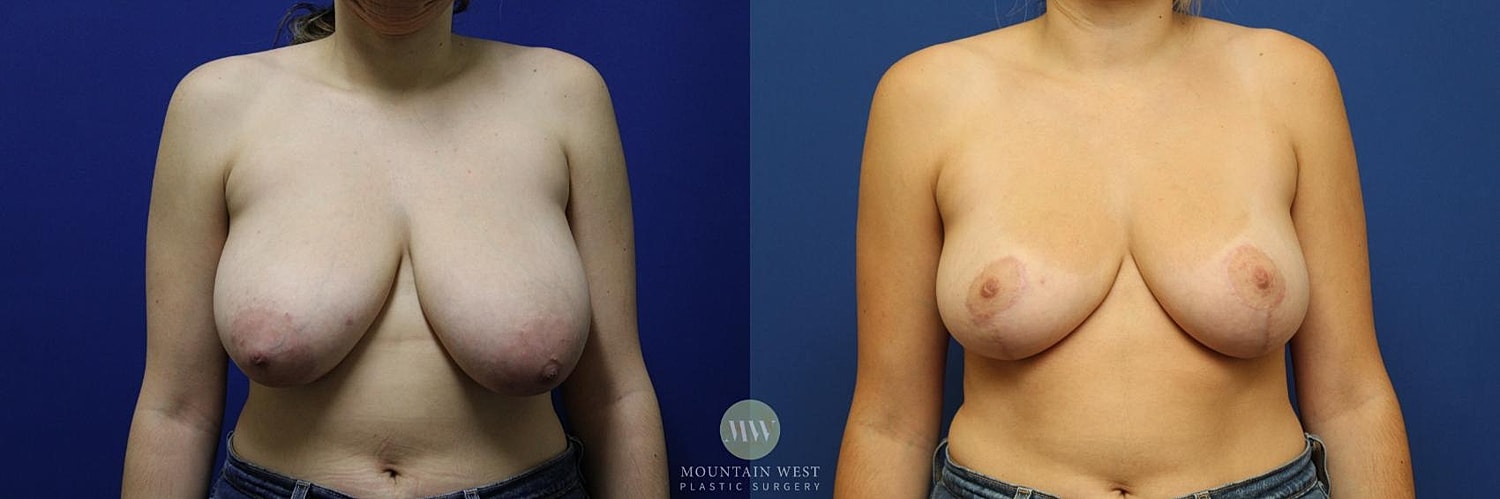 Breast Reduction Before & After