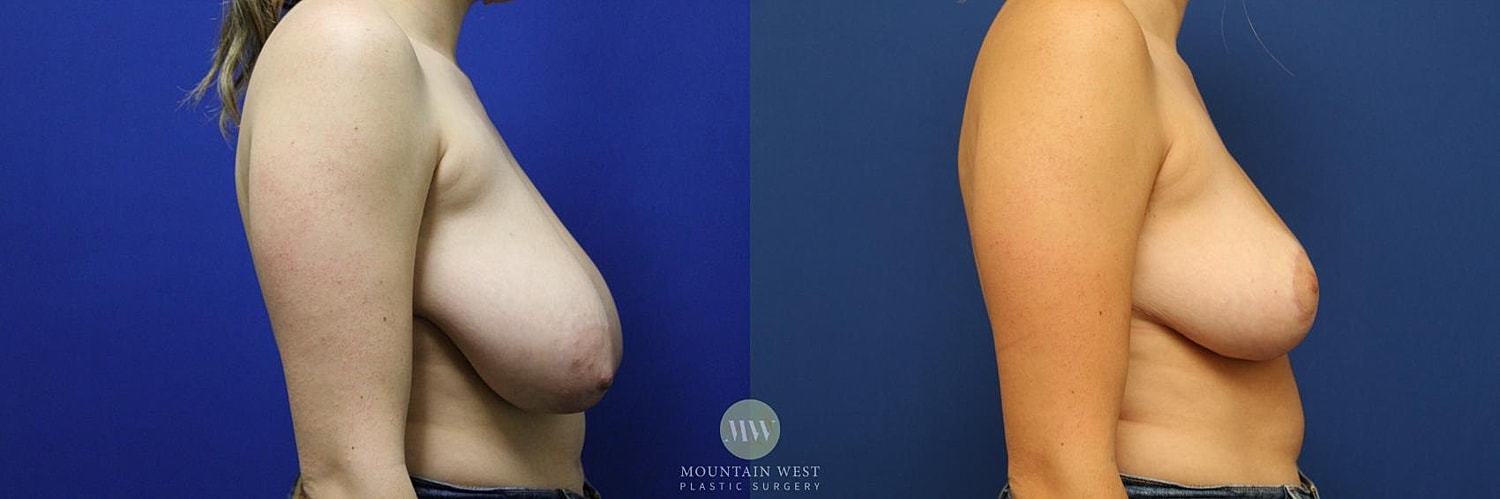 Breast Reduction Before & After