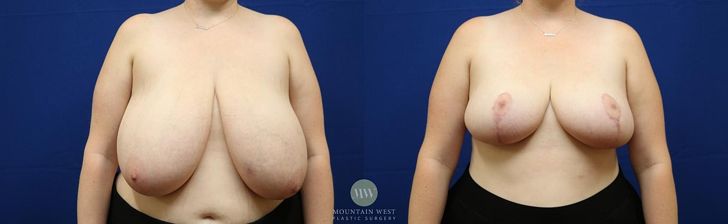 Breast Reduction Before & After