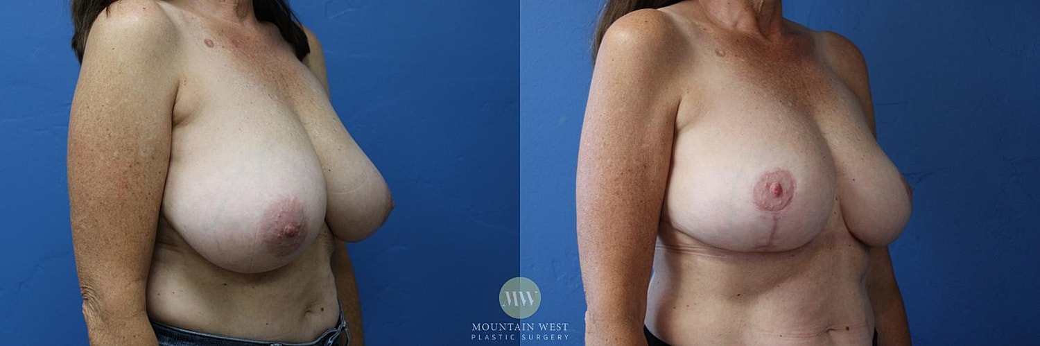Breast Reduction Before & After