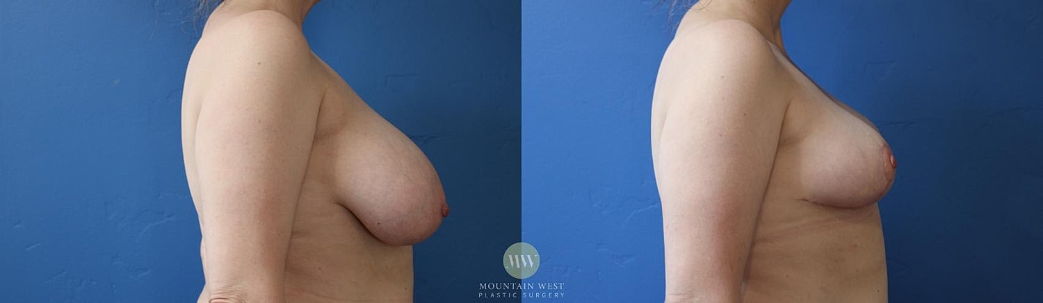 Breast Reduction Before & After