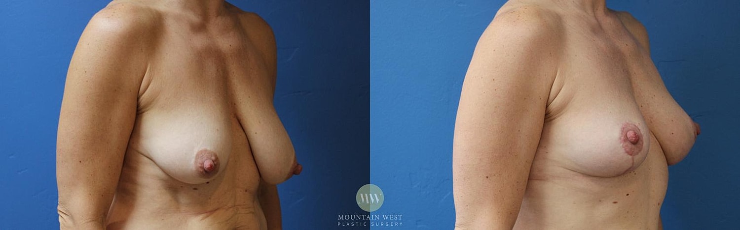 Breast Reduction Before & After