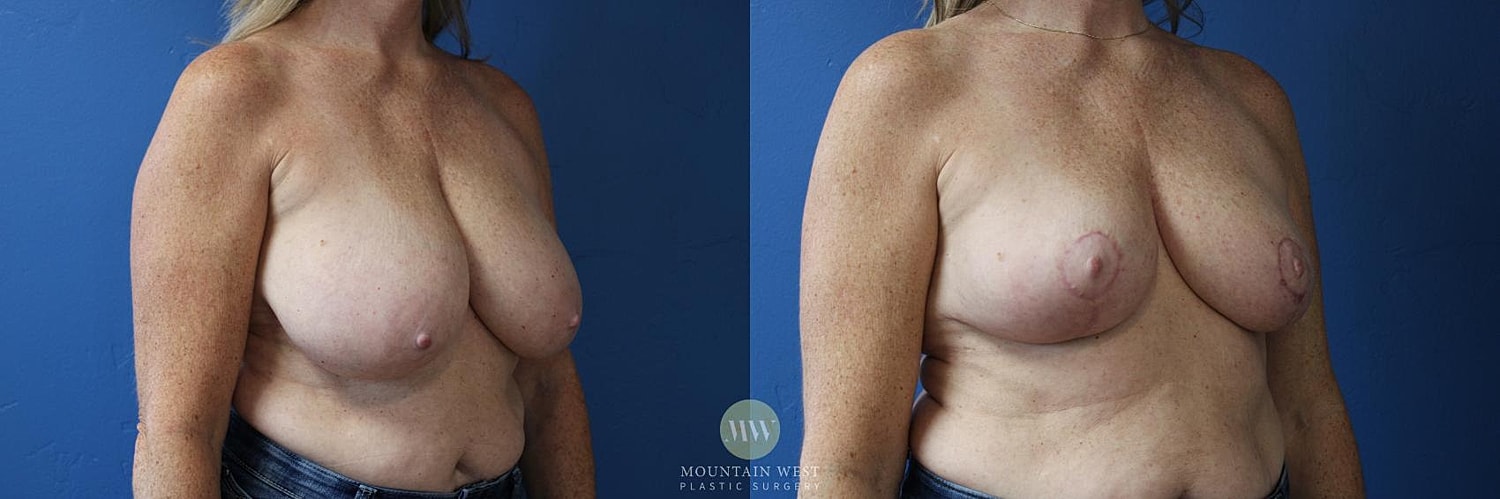 Breast Reduction Before & After