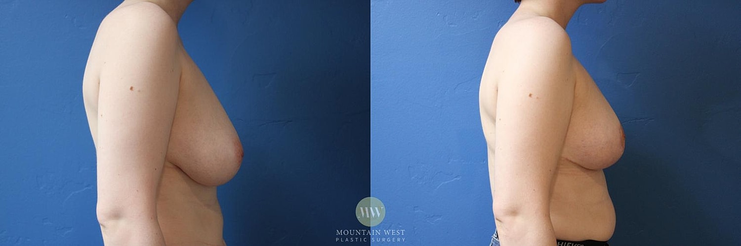 Breast Reduction Before & After