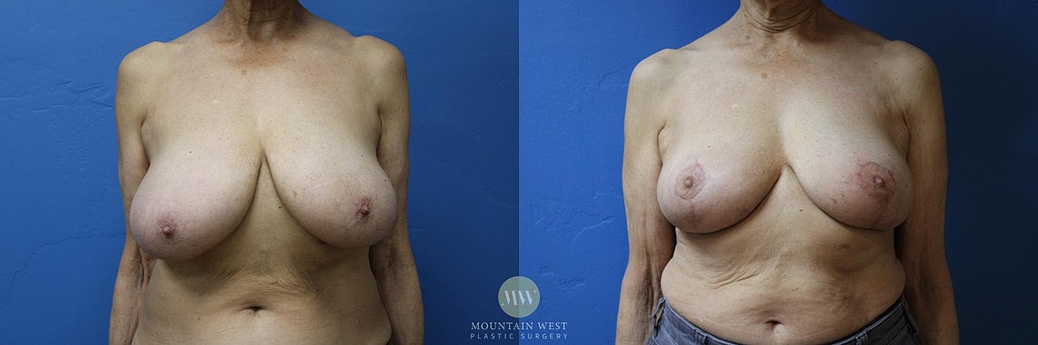 Breast Reduction Before & After