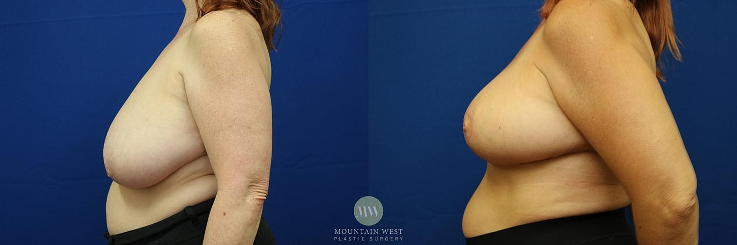 Breast Reduction Before & After
