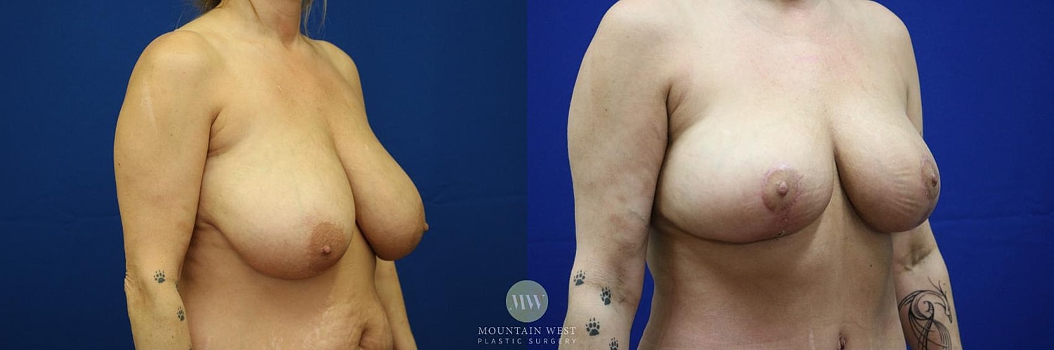 Breast Reduction Before & After
