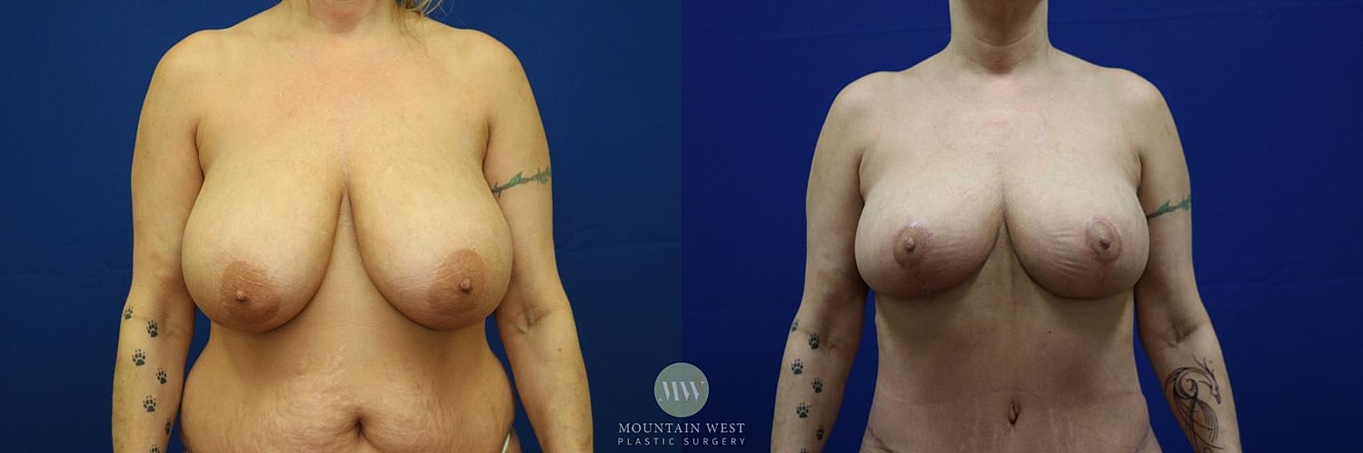 Breast Reduction Before & After