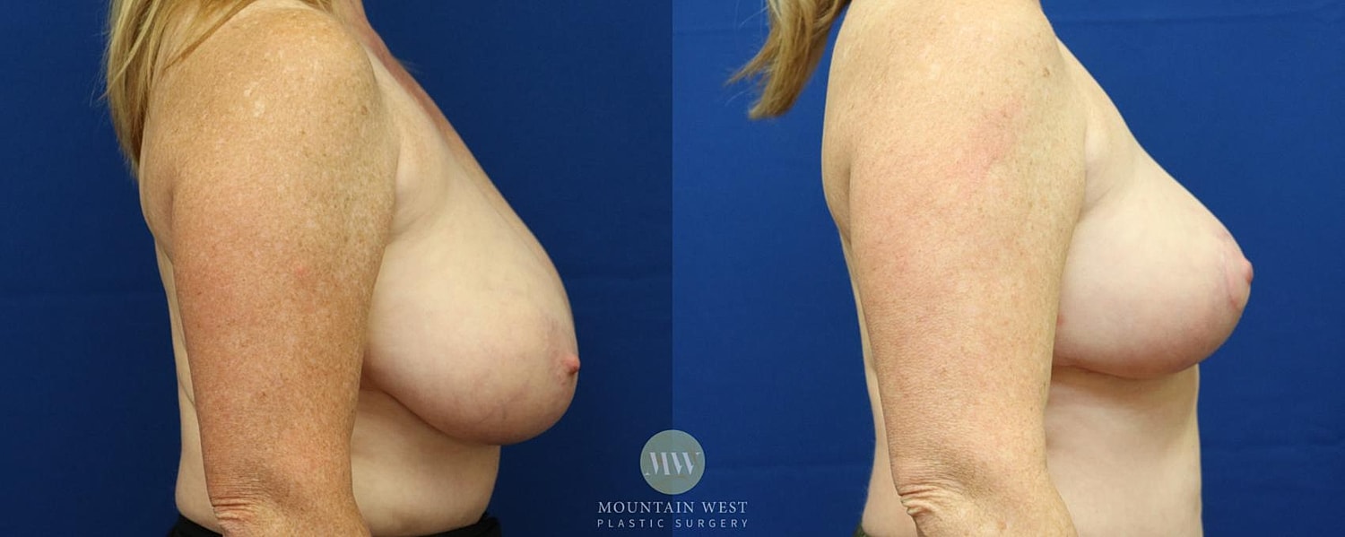 Breast Reduction Before & After