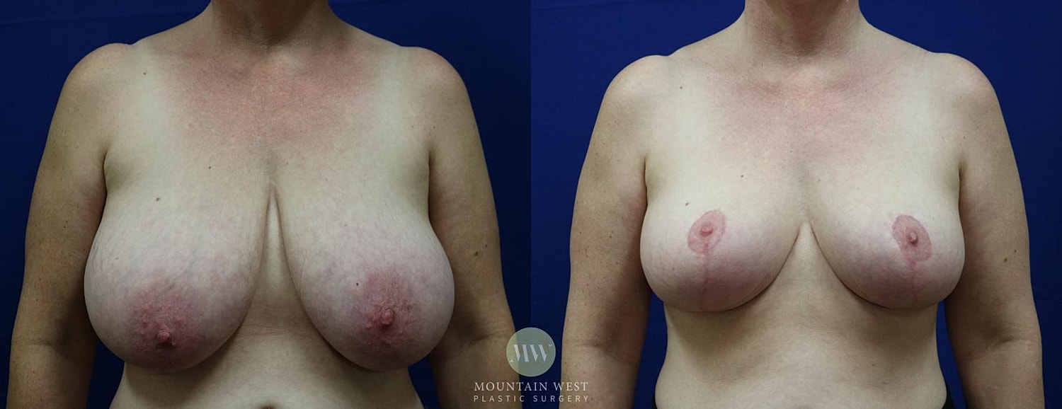 Breast Reduction Before & After