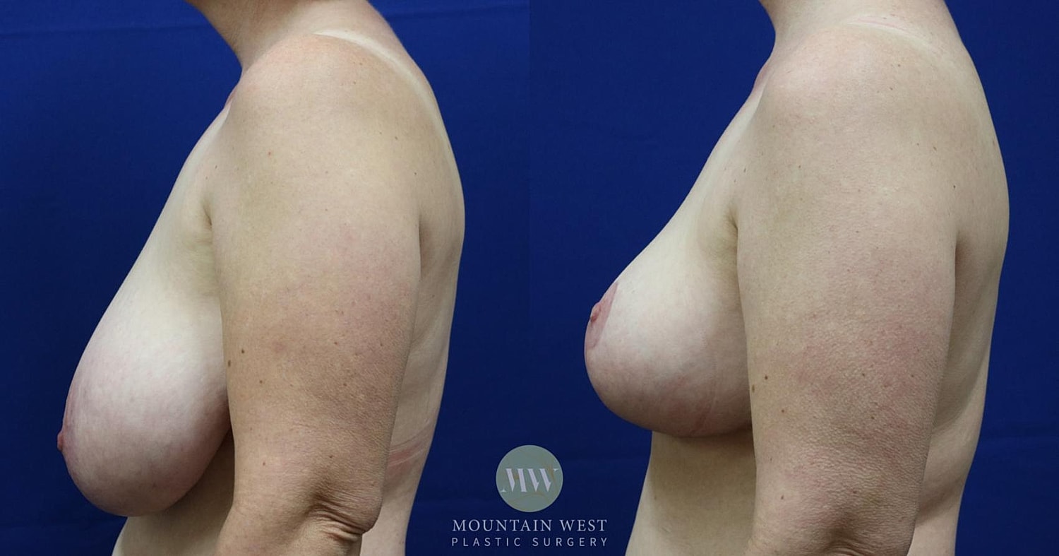 Breast Reduction Before & After
