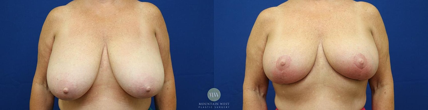 Breast Reduction Before & After