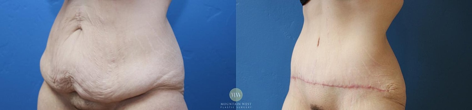 Body Contouring After Weight Loss Before & After