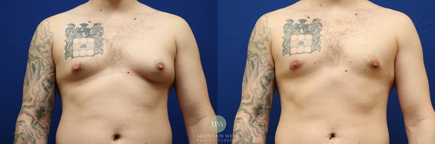 Male Breast Reduction Gynecomastia Before & After