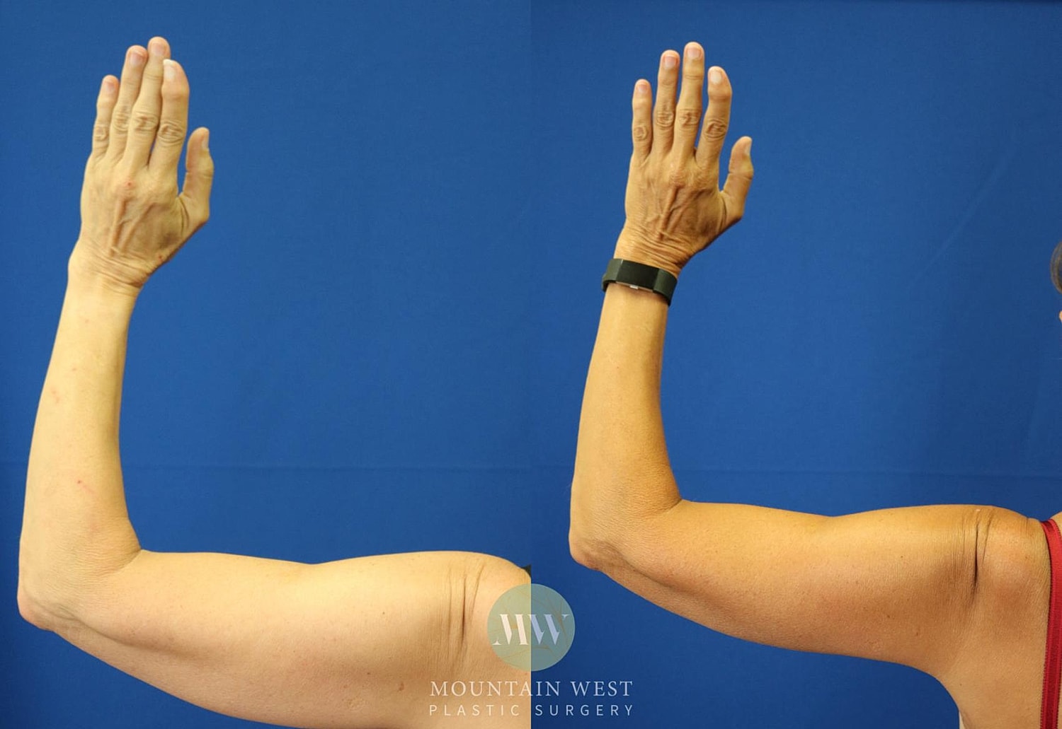 Arm Lift Before & After