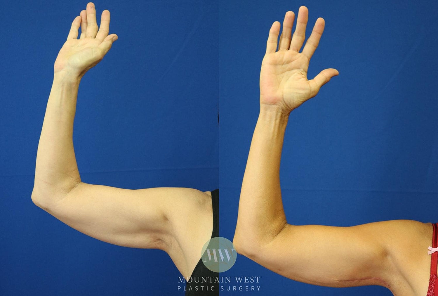 Arm Lift Before & After