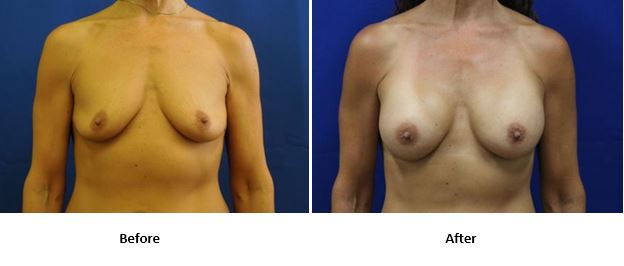Breast augmentation before-and-after photos