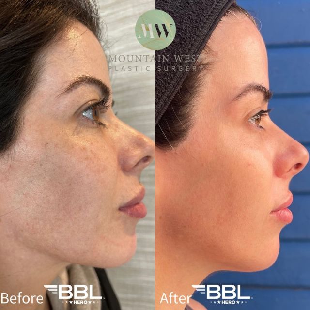 Wow look at these BBL results! Call us today to schedule your consultation and learn more about Sciton laser. 406-609-0211